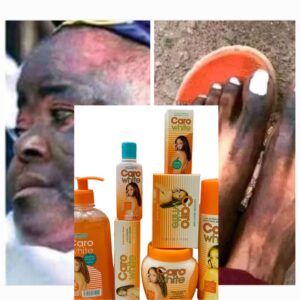 Read more about the article Caro White Cream Side Effects: A Comprehensive Guide