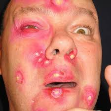 Read more about the article Anti-Pimple Soap Review: Does It Really Work for Clearer Skin?